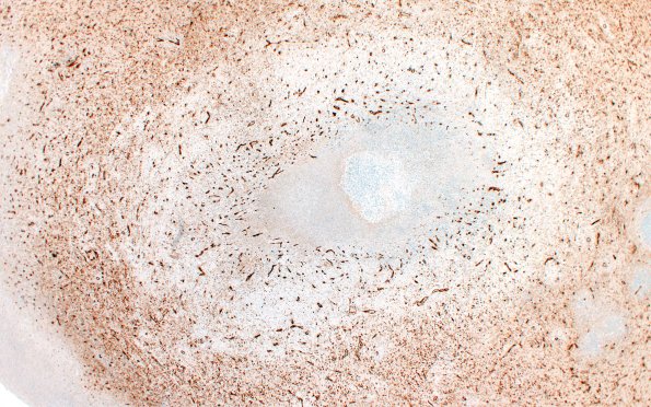 17I3 Abscess A (Case 17) N12 CD31 2X