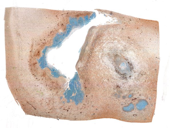 17J1 Abscess (Case 17) N12 CD45 WM 2