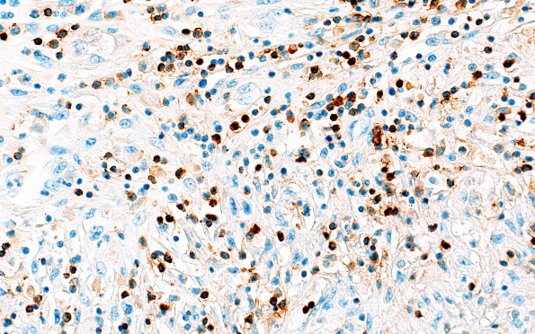 17J3 Abscess A (Case 17) N12 CD45 40X