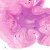 2A Abscess (ts) copy 3