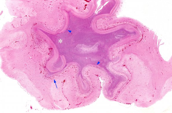 2A Abscess (ts) copy 3