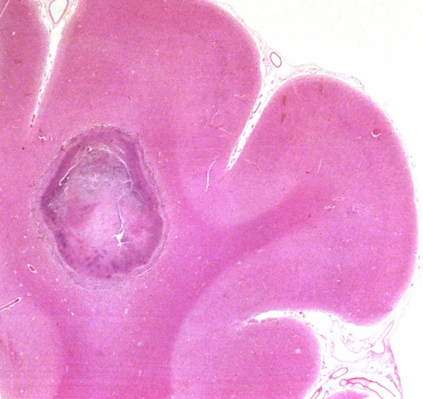 2E Abscess, H&E