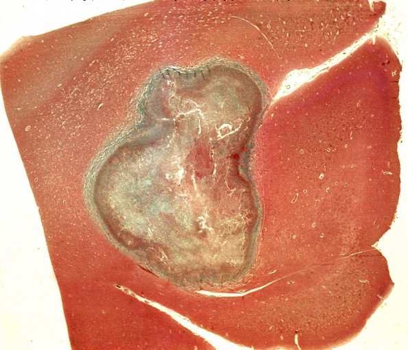 2F Abscess, Trichrome 1