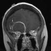 3A1 Abscess (Case 3) T1 W 2 copy - Copy