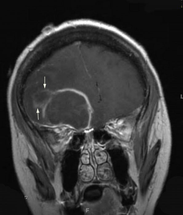 3A1 Abscess (Case 3) T1 W 2 copy - Copy