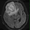 3A2 Abscess (Case 3) FLAIR 1 - Copy - Copy