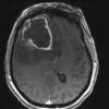 3A3 Abscess (Case 3) T1 W 3 - Copy - Copy