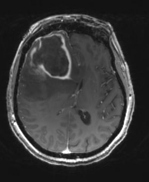 3A3 Abscess (Case 3) T1 W 3 - Copy - Copy