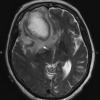 3A4 Abscess (Case 3) T2 1 - Copy copy