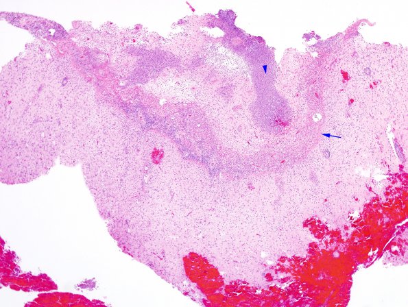 3B1 Abscess (Case 3) H&E 4X copy