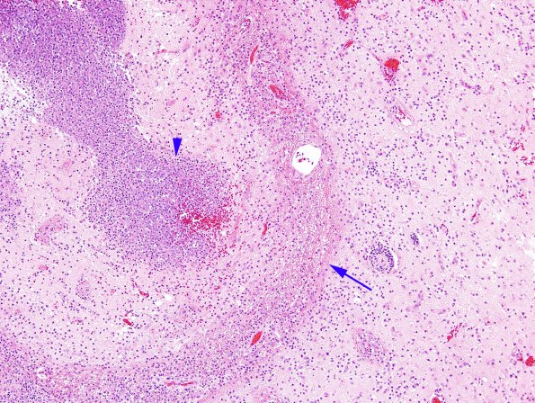 3B2 Abscess (Case 3) H&E 10X copy