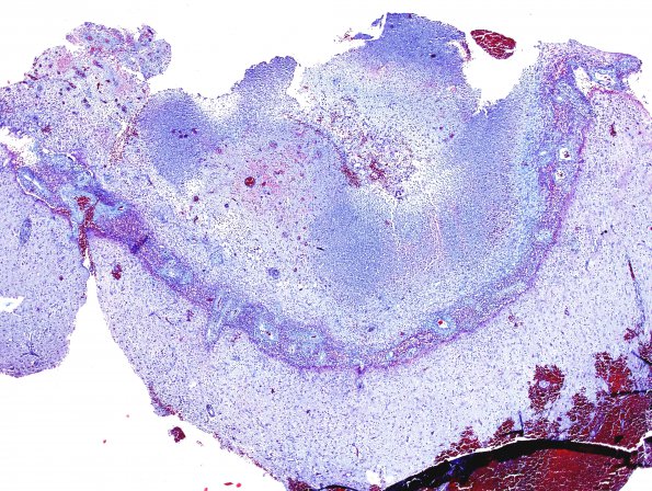 3C1 Abscess (Case 3) Trichrome 4X