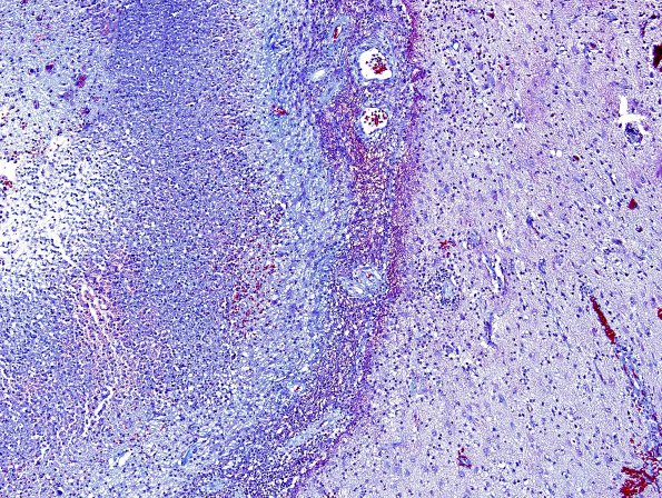 3C2 Abscess (Case 3) Trichrome 10X