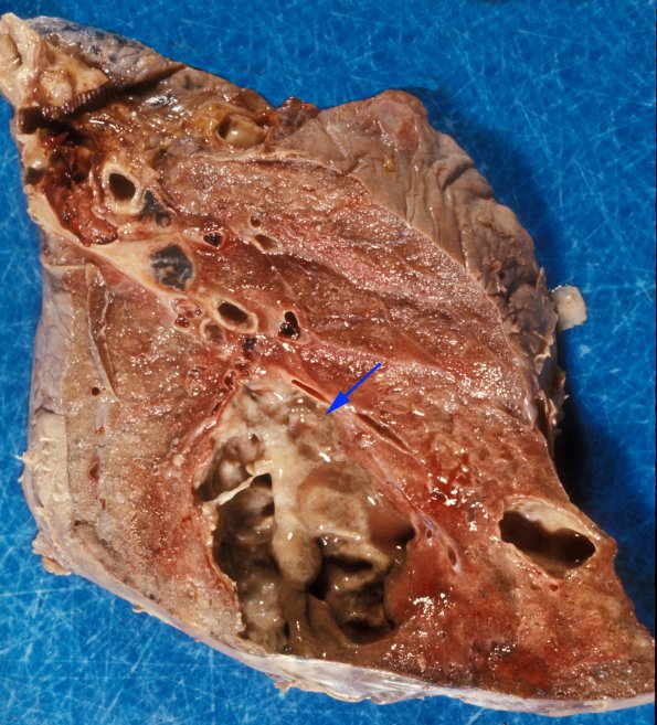 4A Abscess, (Multiple cases) gross 1 copy