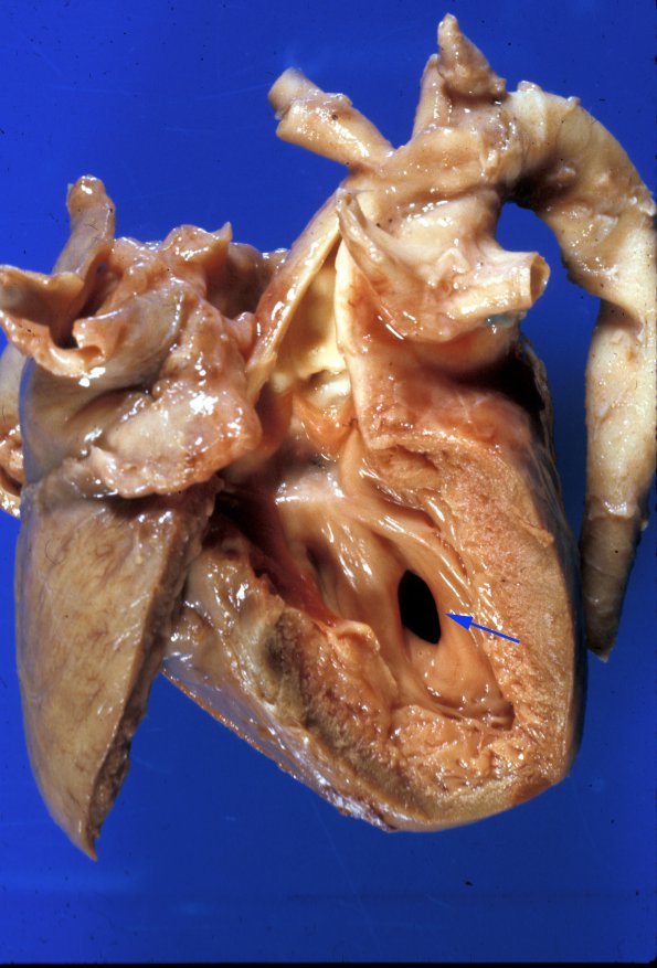 4G Abscess, sources VSD copy