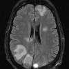 5A1 Abscesses, multiple (Case 5) FLAIR 1 - Copy