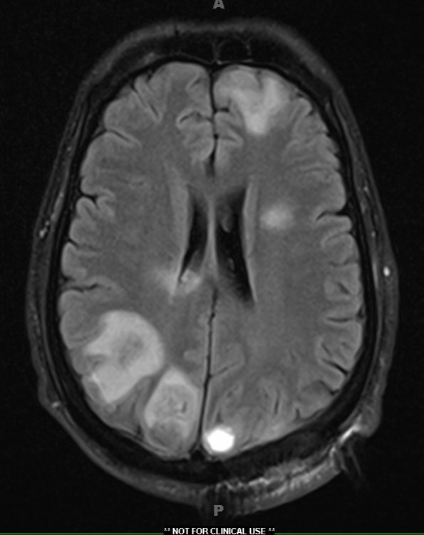 5A1 Abscesses, multiple (Case 5) FLAIR 1 - Copy