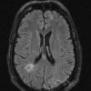 5A2 Abscesses, multiple (Case 5) FLAIR 3 months later - Copy