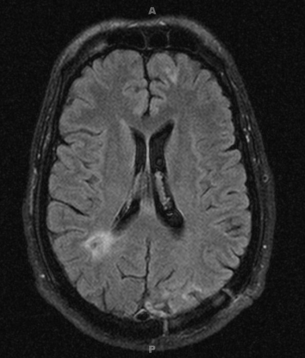 5A2 Abscesses, multiple (Case 5) FLAIR 3 months later - Copy