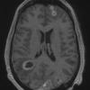 5A3 Abscesses, multiple (Case 5) T1 W 2 - Copy