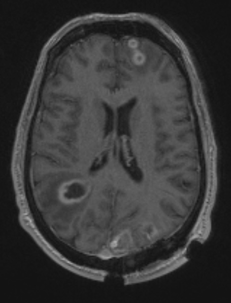 5A3 Abscesses, multiple (Case 5) T1 W 2 - Copy