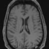 5A4 Abscesses, multiple (Case 5) T1 W 3 months later 1 - Copy