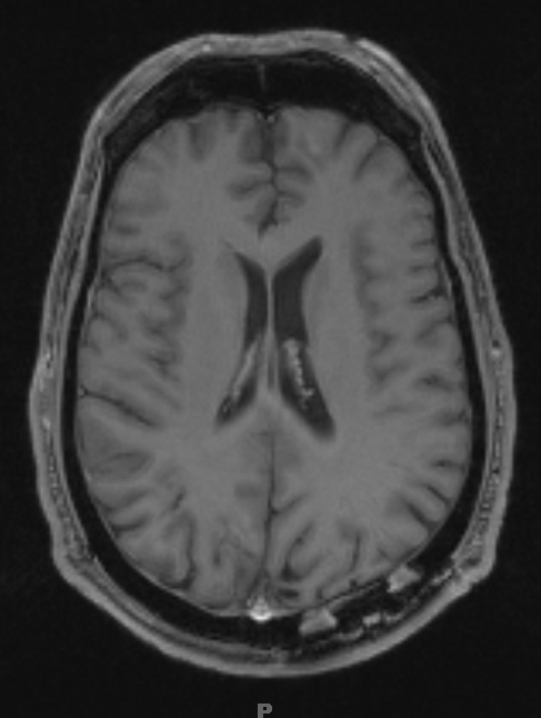 5A4 Abscesses, multiple (Case 5) T1 W 3 months later 1 - Copy