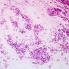 5B1 Abscess, acute and chronic (Case 5) Smear H&E 2