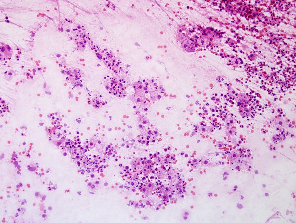 5B1 Abscess, acute and chronic (Case 5) Smear H&E 2