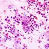 5B2 Abscess, acute and chronic (Case 5) Smear H&E 1 copy