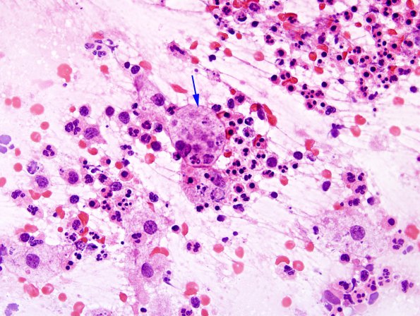 5B2 Abscess, acute and chronic (Case 5) Smear H&E 1 copy