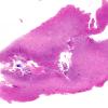 5B4 Abscess, acute and chronic (Case 5) H&E whole mount copy