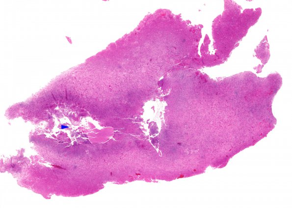 5B4 Abscess, acute and chronic (Case 5) H&E whole mount copy