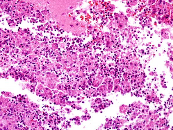 5B5 Abscess, acute and chronic (Case 5) H&E 4