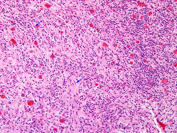 5B6 Abscess, acute and chronic (Case 5) H&E 5 copy