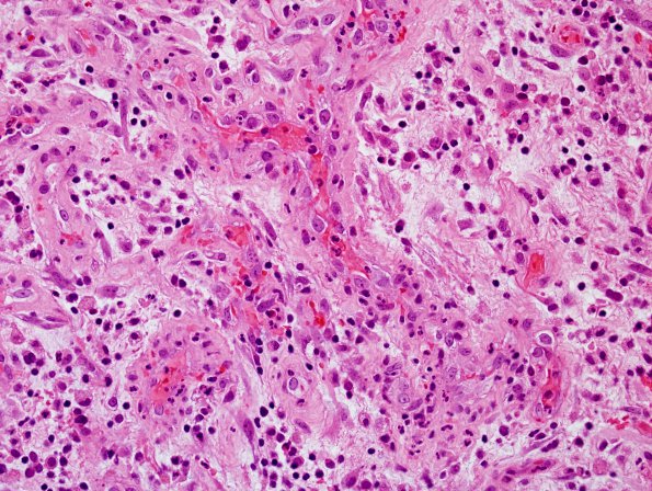 5B7 Abscess, acute and chronic (Case 5) H&E 3