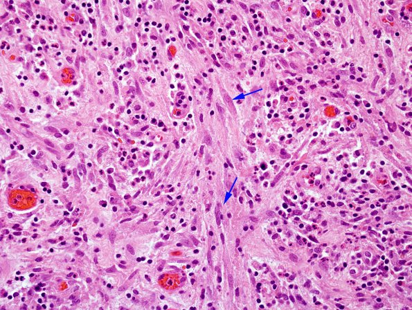 5B8 Abscess, acute and chronic (Case 5) H&E 2 copy