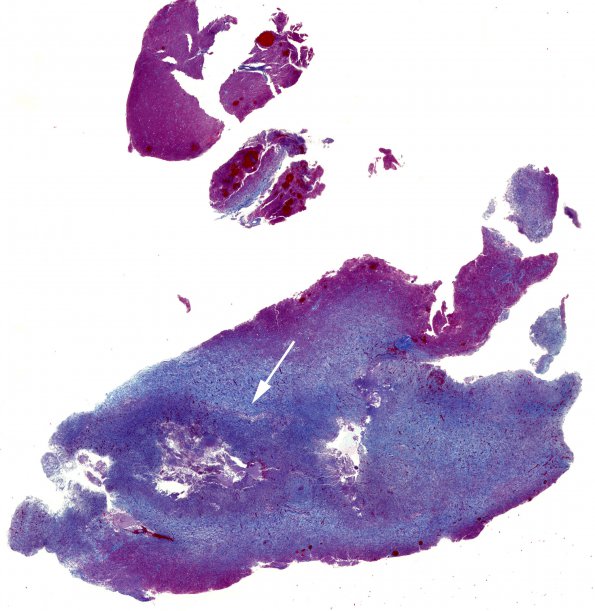 5C1 Abscess, acute and chronic (Case 5) Trichrome whole mount copy