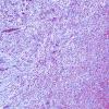 5C2 Abscess, acute and chronic (Case 5) 10X areaA Trichrome 1