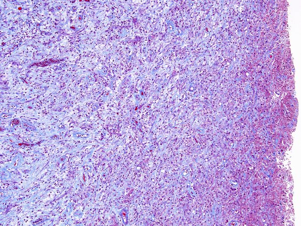 5C2 Abscess, acute and chronic (Case 5) 10X areaA Trichrome 1