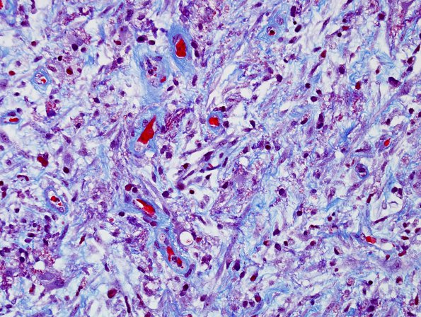 5C5 Abscess, acute and chronic (Case 5) 20X areaA Trichrome 20X