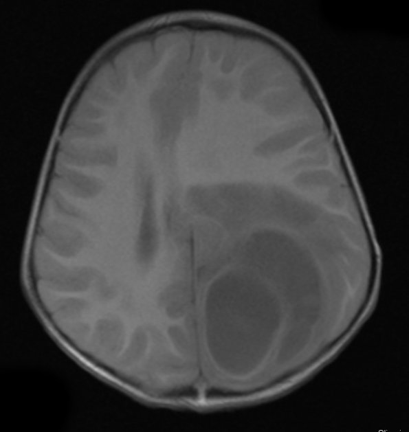 6A1 Abscess, bacterial, acute & chronic (Case 6) T1 - Copy - Copy