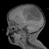 6A2 Abscess, bacterial, acute & chronic (Case 6) T1 - Copy