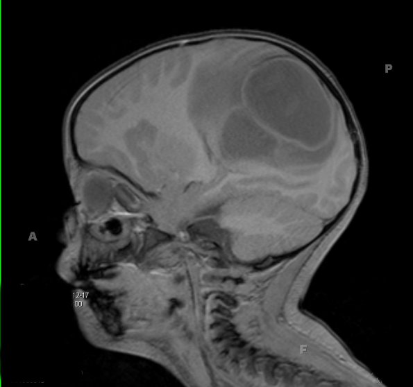 6A2 Abscess, bacterial, acute & chronic (Case 6) T1 - Copy