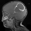 6A3 Abscess, bacterial, acute & chronic (Case 6) T1 W - Copy