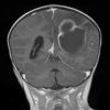 6A4 Abscess, bacterial, acute & chronic (Case 6) T1 W 2 - Copy