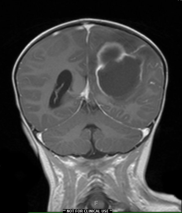 6A4 Abscess, bacterial, acute & chronic (Case 6) T1 W 2 - Copy