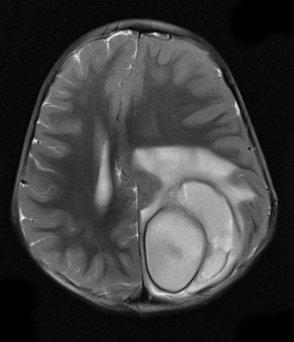 6A5 Abscess, bacterial, acute & chronic (Case 6) T2 - Copy