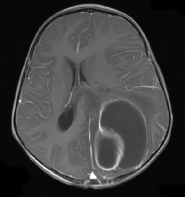 6A6 Abscess, bacterial, acute & chronic (Case 6) T1 - Copy