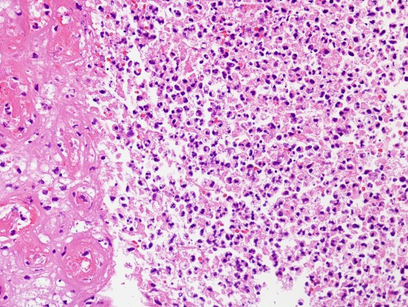 6B1 Abscess, acute & chronic (Case 6) H&E 15